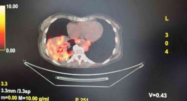 'Sigarasız akciğer kanseri' vakalarında dikkat çeken artış