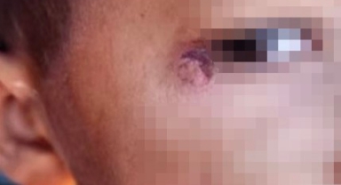 Okulda dehşet olay! Öğrencinin yüzünde sigara söndürdü