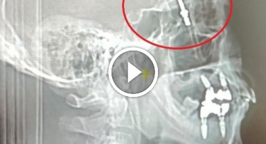 Beynine saplanan implant hayatını kararttı: 2 yıldır adalet bekliyor